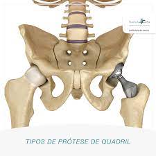 Cirurgia de prótese de quadril pode ser diferente para mulheres e homens: saiba o que é mito e verdade