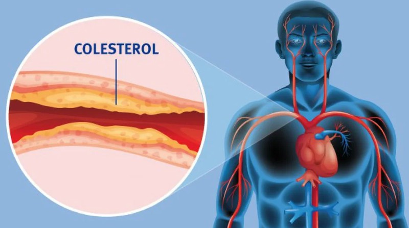 Controle seu colesterol com exercícios e boa alimentação 