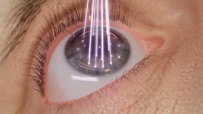 Médico do H.Olhos - Unidade Laser Ocular, esclarece dúvidas sobre a Cirurgia Refrativa